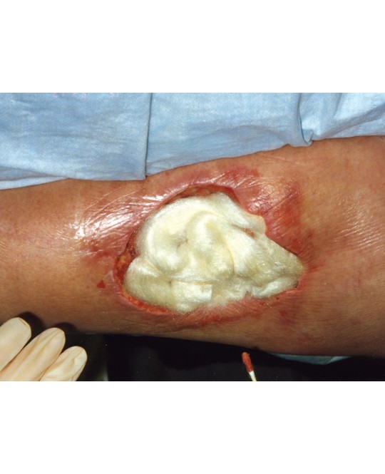 TEGADERM 3M ALGINATE 10x10 cm