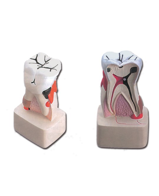 MODELLO PATOLOGIA DENTALE