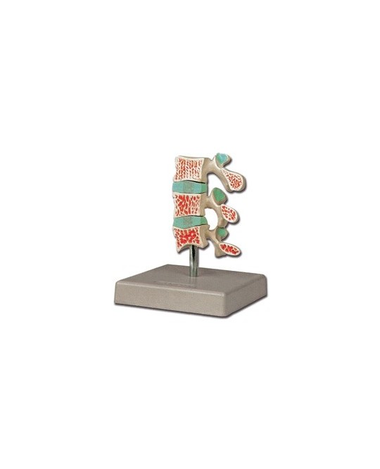 MODELLO OSTEOPOROSI