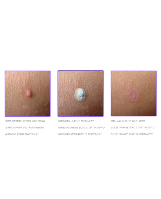 DISPOSITIVO CRIOCHIRURGICO CRYOMEGA con cartuccia 16 g
